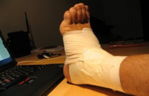 El curioso origen del término ‘esguince’